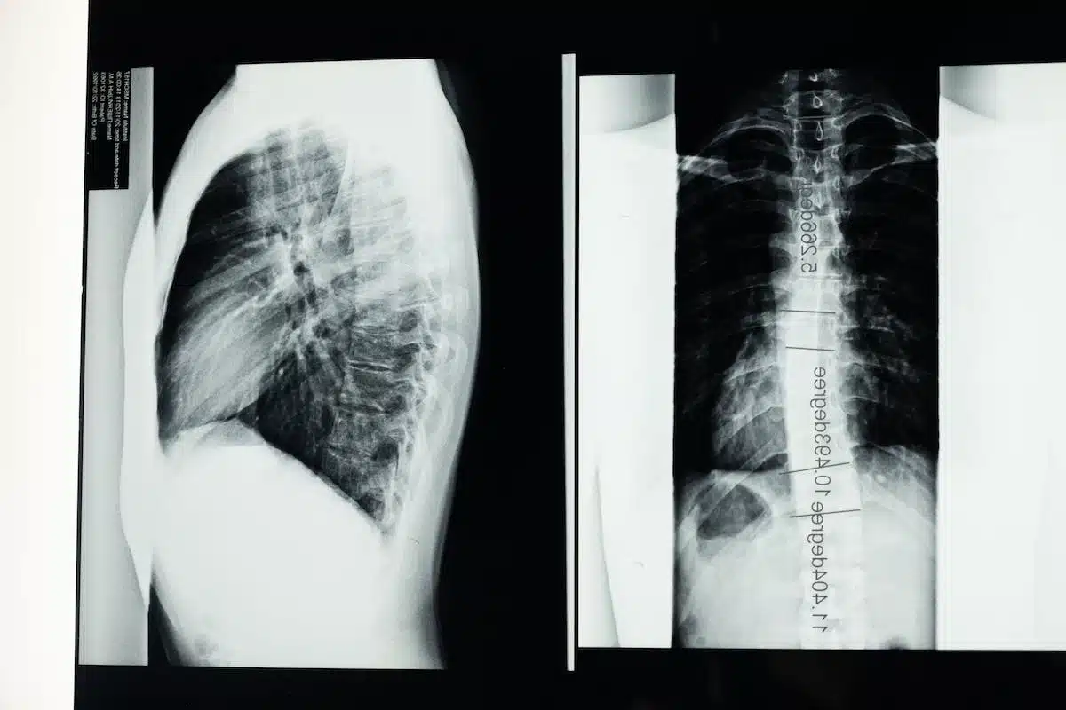 radiographie épaule